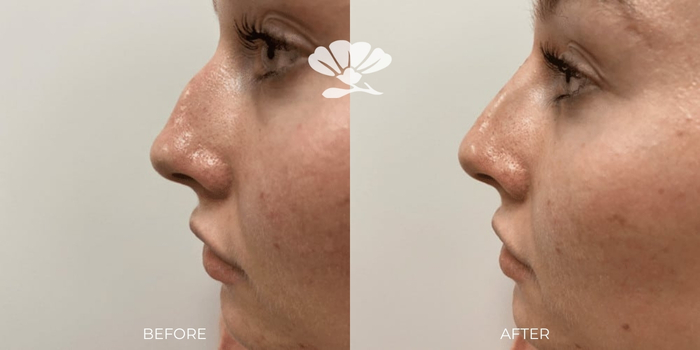 Non Surgical Injectable Rhinoplasty by Dr. Murray Before and After