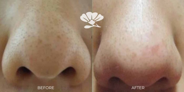 Vivace Radiofrequency microneedling Perth
